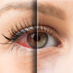 glaucoma specialist in Delhi.png
