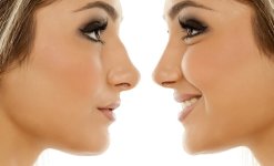 Rhinoplasty-Dr-Lokesh-Handa-Plastic-Surgeon-in-Delhi-02.jpg