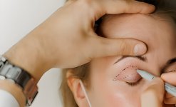 Who-are-the-Good-Candidates-for-Blepharoplasty-Eye-Lid-Surgery-01.jpg