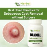 Home Remedies for Sebaceous Cyst.jpg