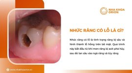 Nhuc-rang-co-lo-la-gi.jpg